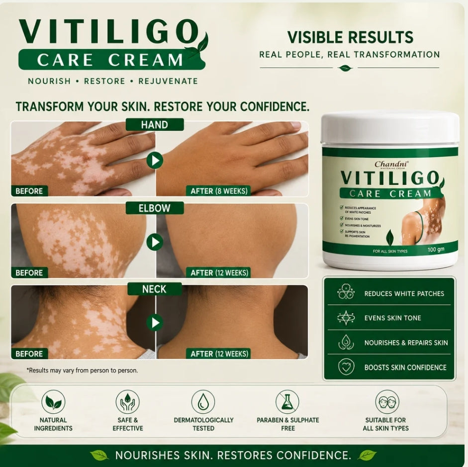 VITILIGO Care Cream (Buy 1 Get 1 FREE)