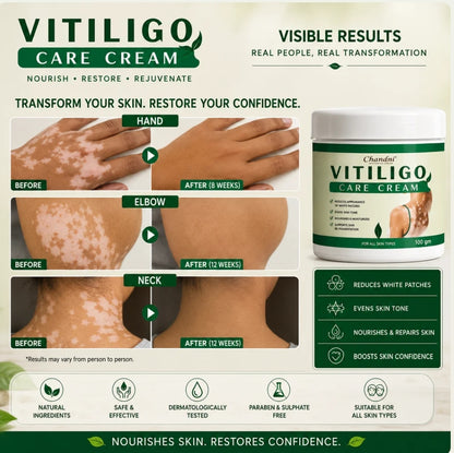 VITILIGO Care Cream (Buy 1 Get 1 FREE)